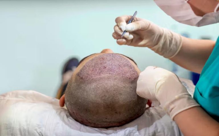 What to Expect Pre-, During, & Post- Hair Transplant Surgery