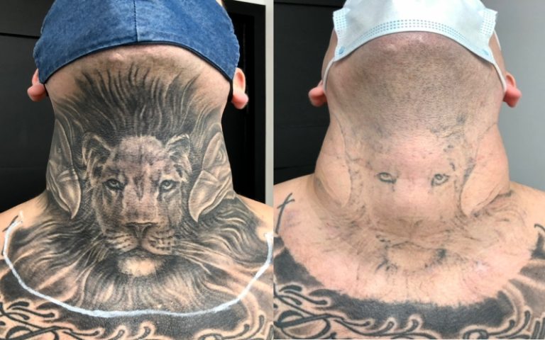 How Many Sessions Are Needed for Complete Tattoo Removal?