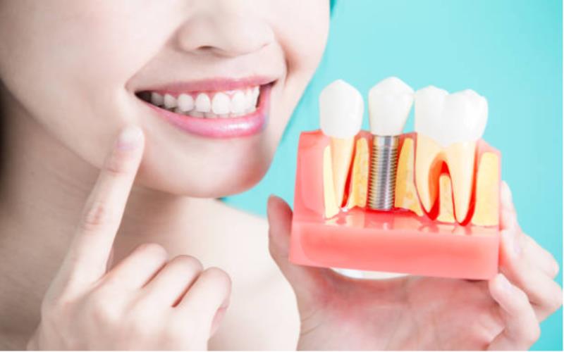 Perfect Your Smile: The Comprehensive Guide to Dental Implant Crowns